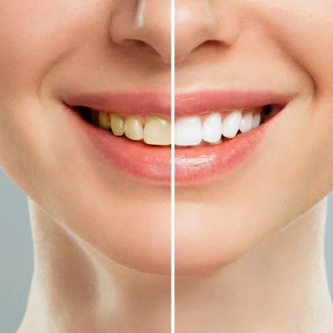 Teeth Whitening